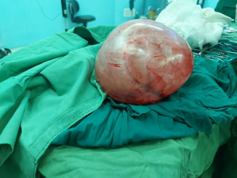 عمل موفقیت آمیز خروج توده ۳ کیلویی از شکم خانم ۴۳ ساله در بیمارستان بهار