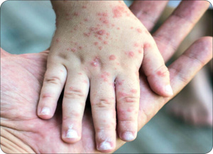 راهنمای مدیریت بالینی ، پیشگیری و کنترل عفونت سرخک در مراکز درمانی