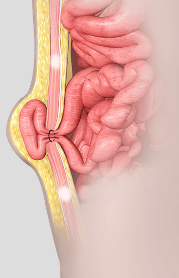 تصویر جراحی فتق شکمی ۱